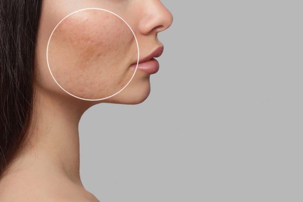 Collagen biostimulation injectable treatment for firmer skin