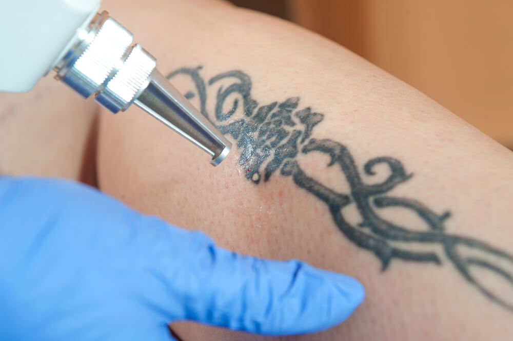 Laser tattoo removal treatment