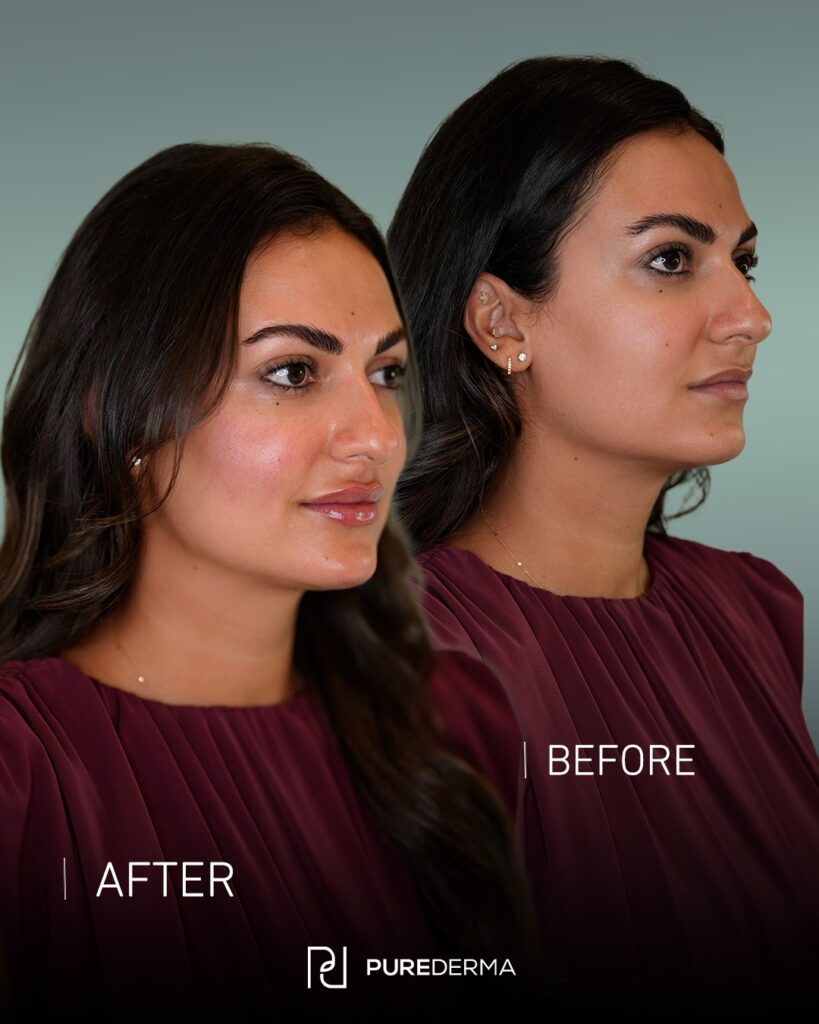 Before and after aesthetic treatment result, case 2