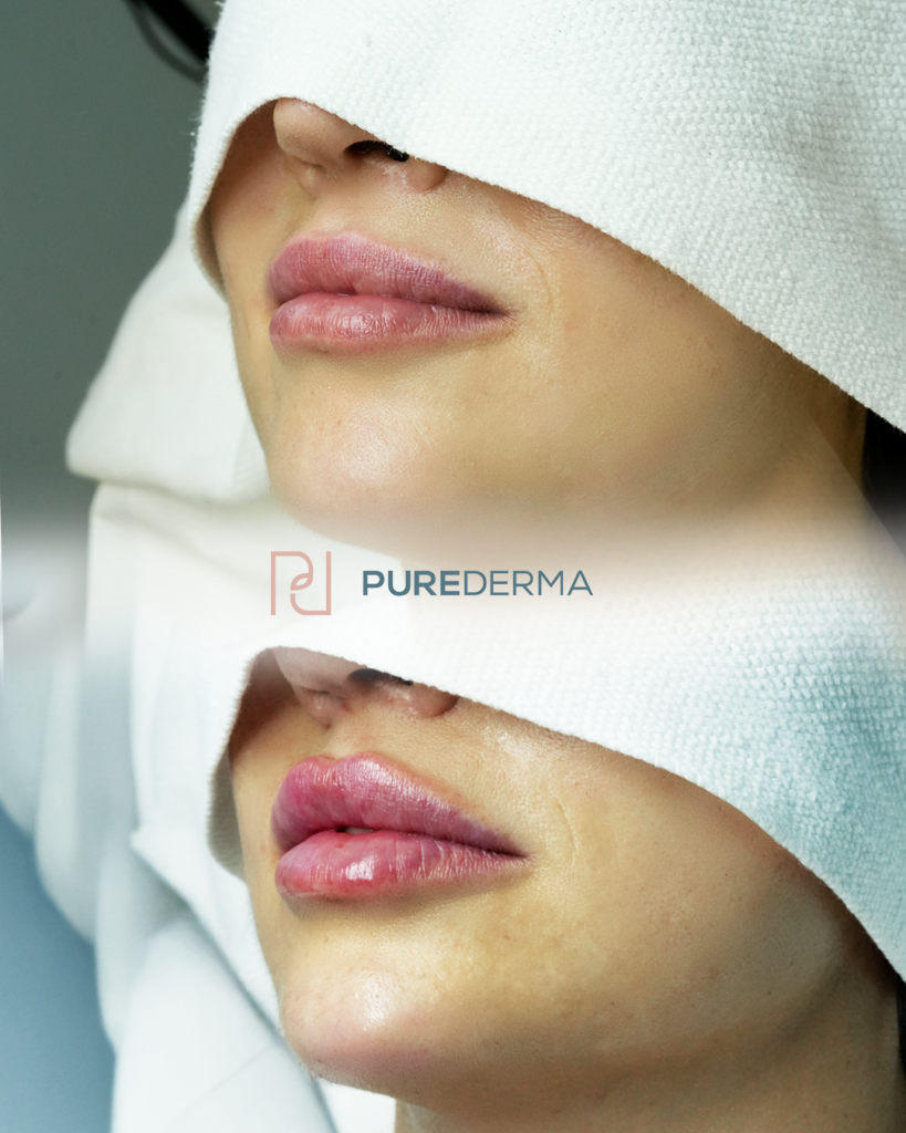 Before and after aesthetic treatment result, case 3