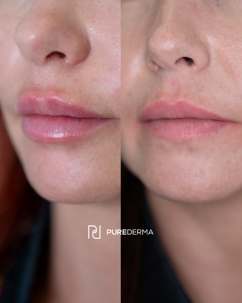 Before and after aesthetic treatment result, case 4
