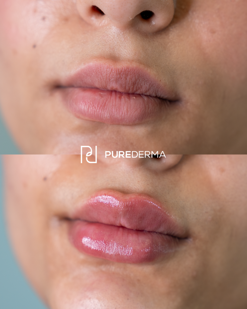 Before and after aesthetic treatment result, case 5