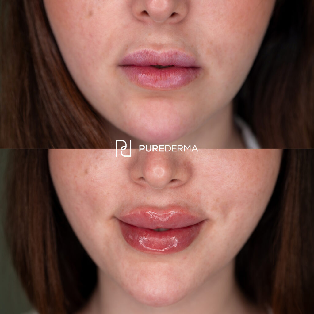 Before and after aesthetic treatment result, case 7