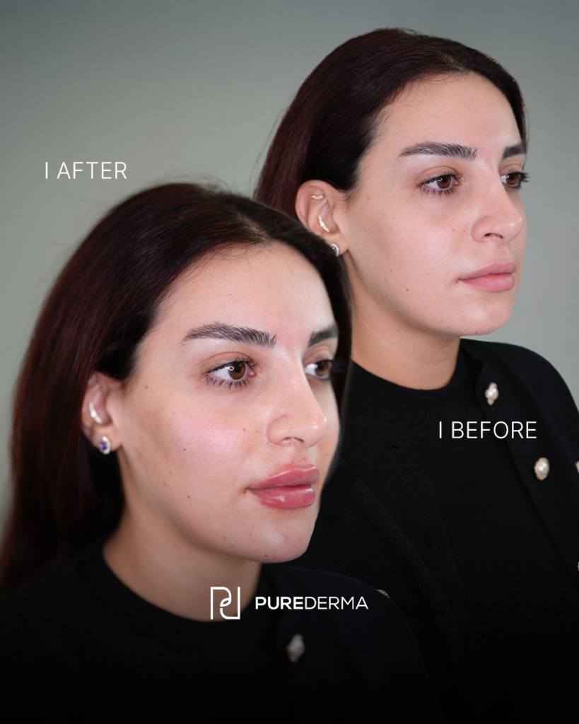 Before and after aesthetic treatment result, case 6